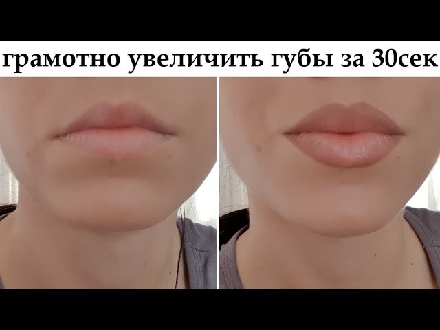 Увеличение / Аугментация губ с помощью 